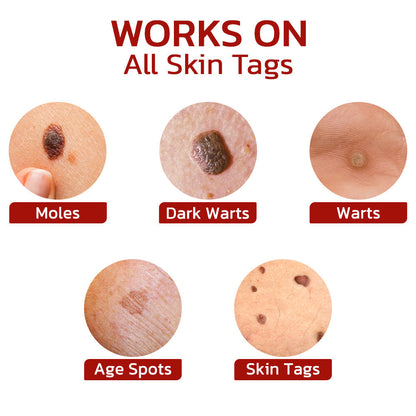 Flyzmus™ WipeOff Tags And Moles Remover